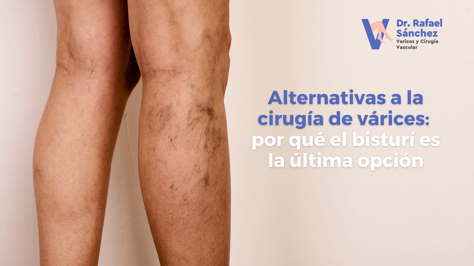 alternativa-cirugia-varices