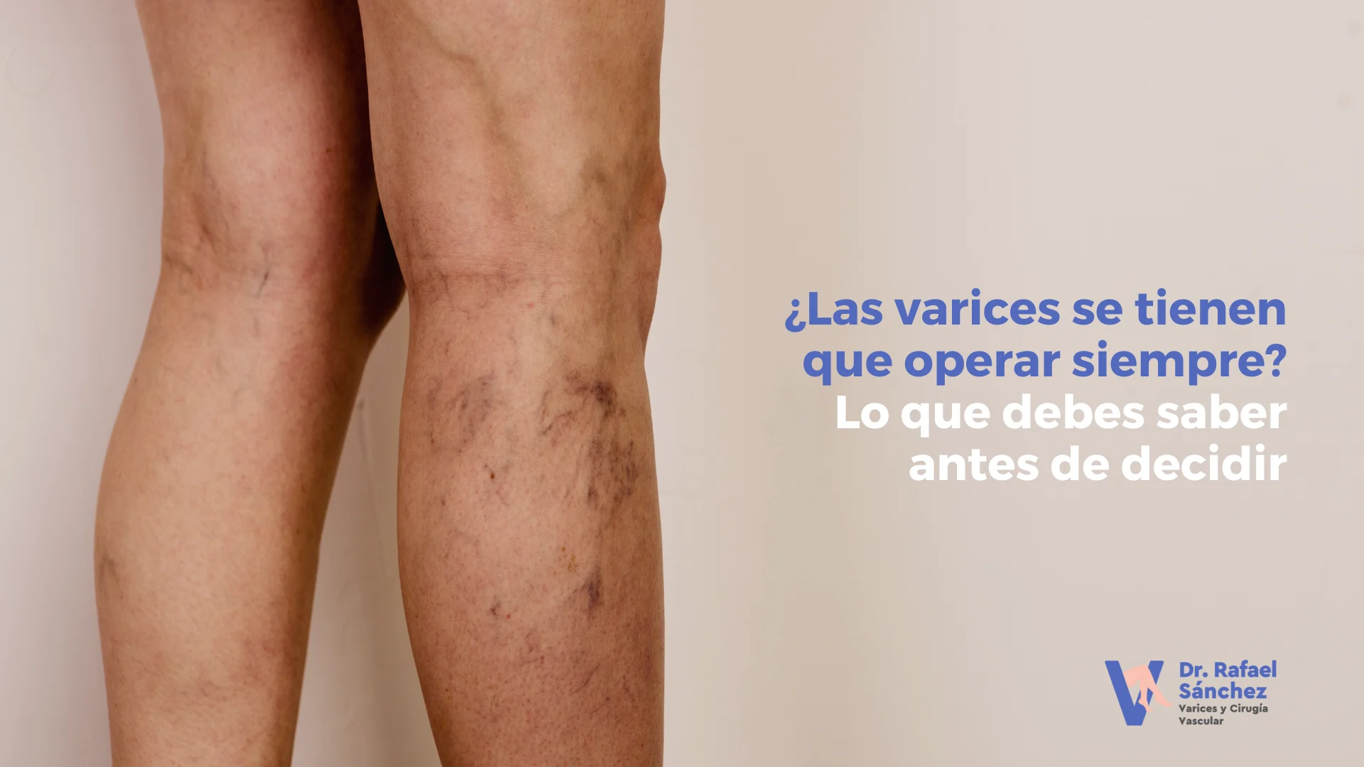 varices-operar-siempre