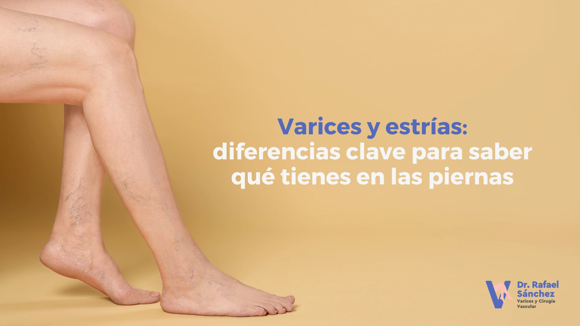 diferencias-varices-estrias